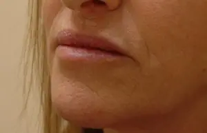 Lip Augmentation Before and After Pictures Fort Lauderdale, FL