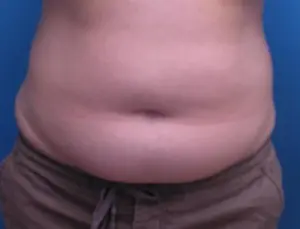 Liposuction Before and After Pictures Fort Lauderdale, FL