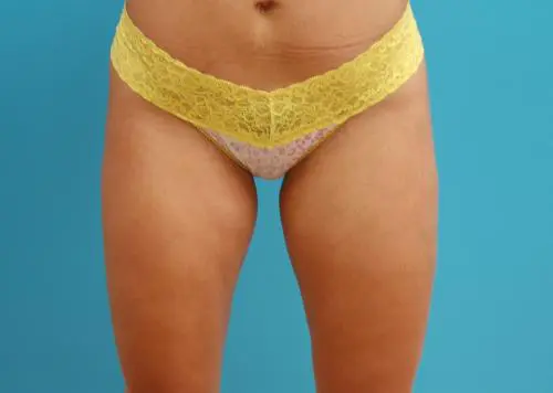 liposuction-38 Liposuction Before and After Pictures Fort Lauderdale, FL