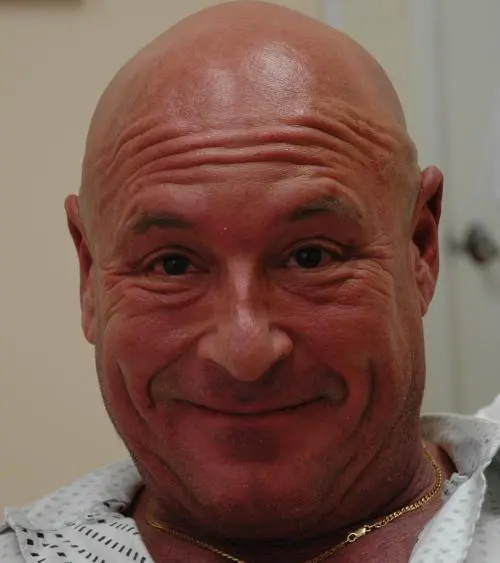 male-botox-dysport-05 Injectable Fillers Before and After Pictures Fort Lauderdale, FL