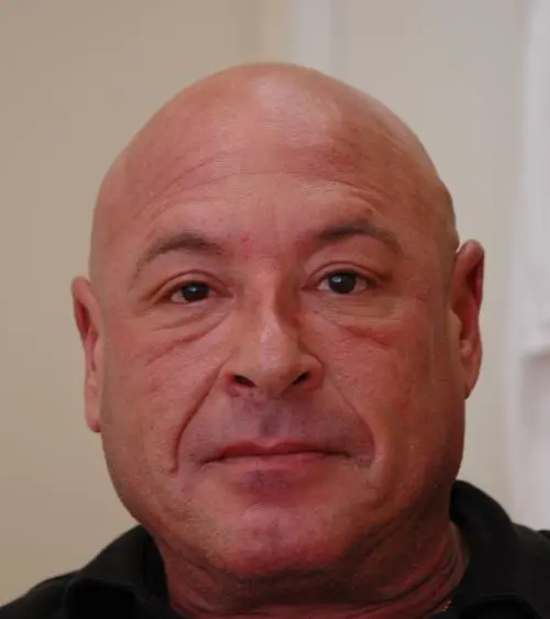 male-botox-dysport-06 Injectable Fillers Before and After Pictures Fort Lauderdale, FL