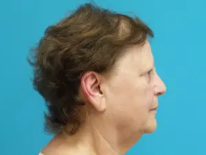 Facelift Before and After Pictures Fort Lauderdale, FL