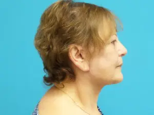 Facelift Before and After Pictures Fort Lauderdale, FL