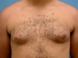Gynecomastia Before and After Pictures Fort Lauderdale, FL