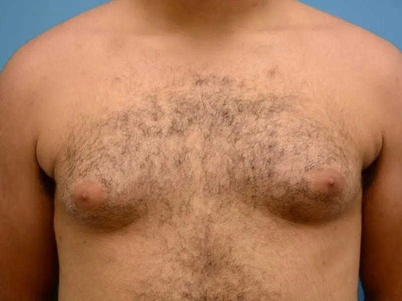 Gynecomastia Before and After Pictures Fort Lauderdale, FL