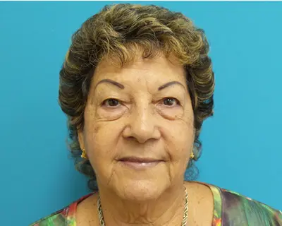 3691192 Blepharoplasty Before and After Pictures Fort Lauderdale, FL