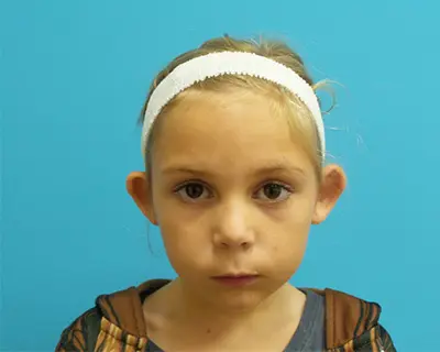 4226527 Otoplasty Before and After Pictures Fort Lauderdale, FL