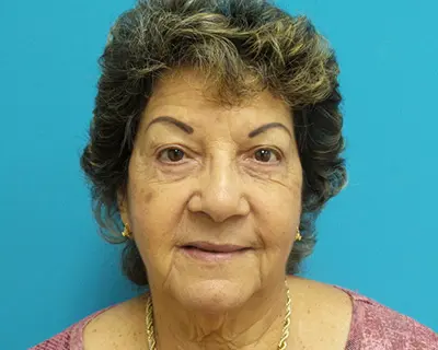 5104838 Blepharoplasty Before and After Pictures Fort Lauderdale, FL