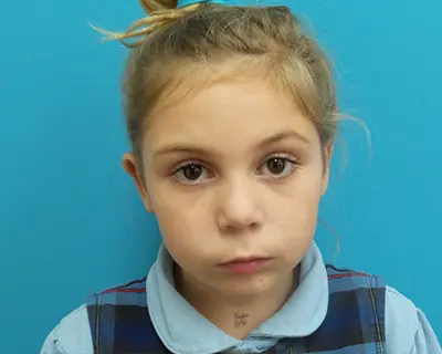 5120440 Otoplasty Before and After Pictures Fort Lauderdale, FL