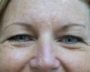 2016-10-20-10-46-39 Blepharoplasty Before and After Pictures Fort Lauderdale, FL