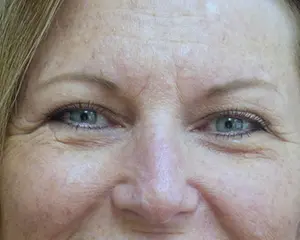 2017-02-03-15-42-58 Blepharoplasty Before and After Pictures Fort Lauderdale, FL