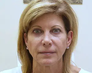 Fillers Before and After Pictures Fort Lauderdale, FL