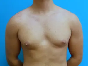 Gynecomastia Before and After Pictures Fort Lauderdale, FL