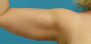 Brachioplasty Before and After Pictures Fort Lauderdale, FL