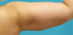 Brachioplasty Before and After Pictures Fort Lauderdale, FL