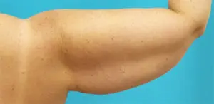 Brachioplasty Before and After Pictures Fort Lauderdale, FL