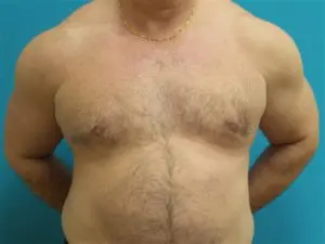 Gynecomastia Before and After Pictures Fort Lauderdale, FL