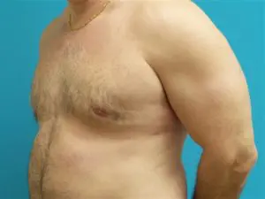 Gynecomastia Before and After Pictures Fort Lauderdale, FL