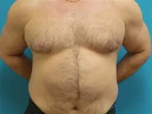 Gynecomastia Before and After Pictures Fort Lauderdale, FL