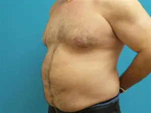 Gynecomastia Before and After Pictures Fort Lauderdale, FL