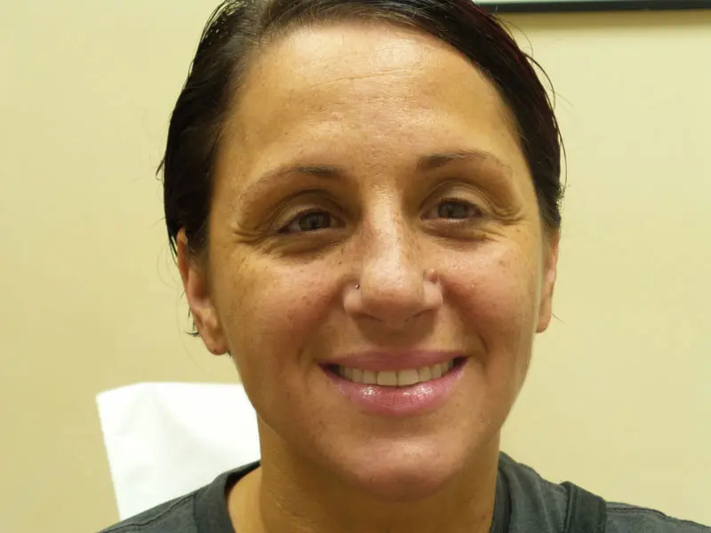 botox-case6-frontalsmile-before Botox/Dysport Before and After Pictures Fort Lauderdale, FL