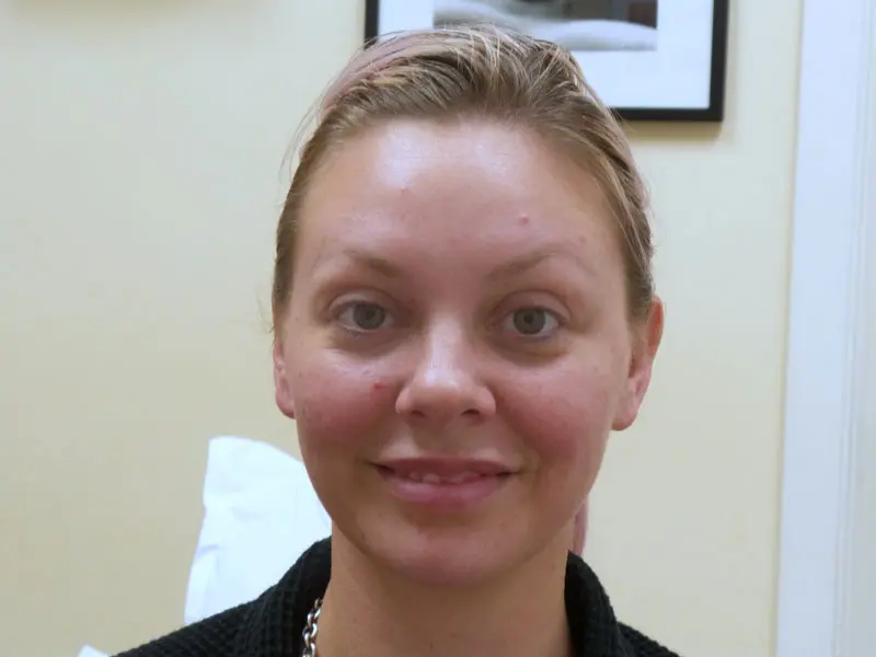 botox-pt7-frontsmile-after Botox/Dysport Before and After Pictures Fort Lauderdale, FL