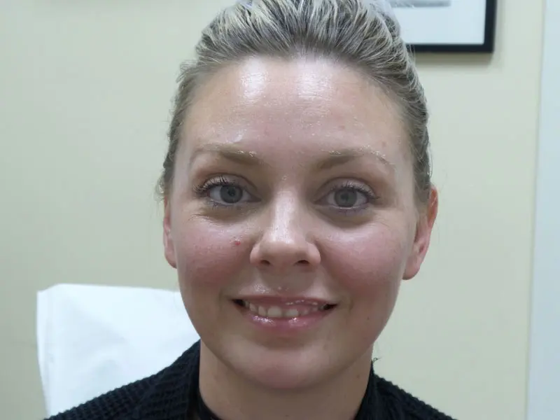 botox-pt7-frontsmile-before Botox/Dysport Before and After Pictures Fort Lauderdale, FL