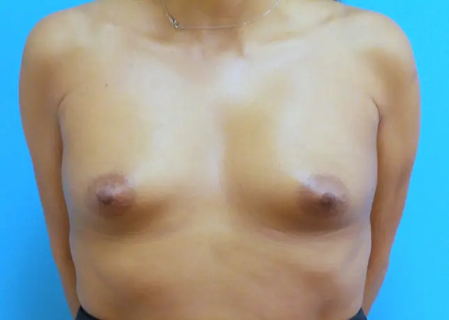 Breast Augmentation Before and After Pictures Fort Lauderdale, FL