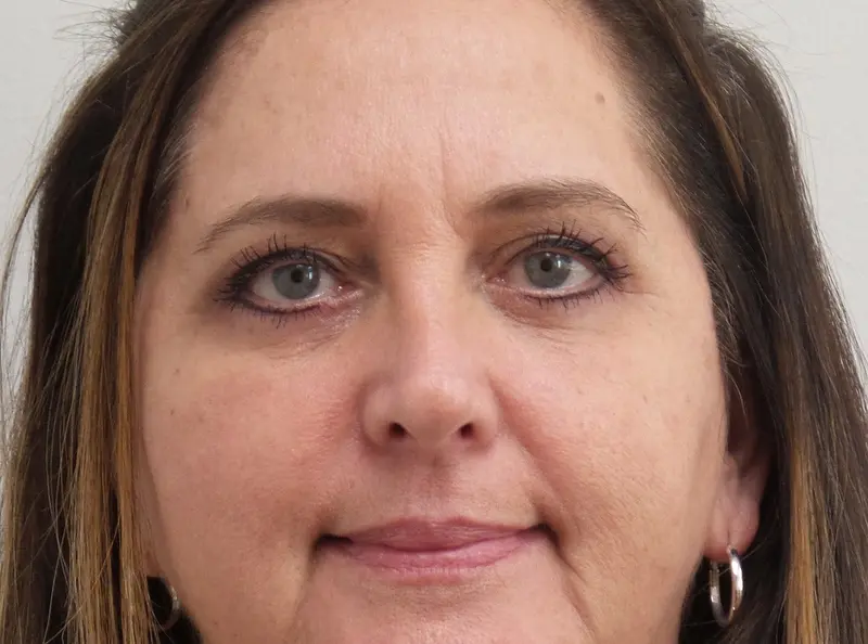 After1 Blepharoplasty Before and After Pictures Fort Lauderdale, FL