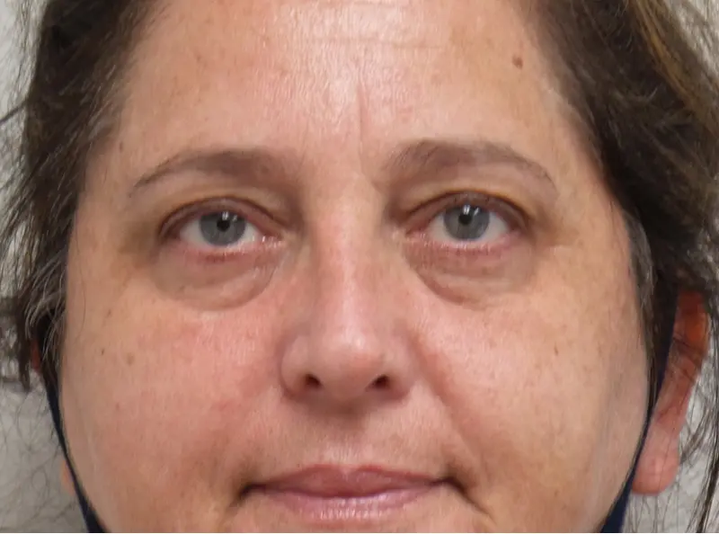 Before1 Blepharoplasty Before and After Pictures Fort Lauderdale, FL