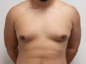 Gynecomastia Before and After Pictures Fort Lauderdale, FL