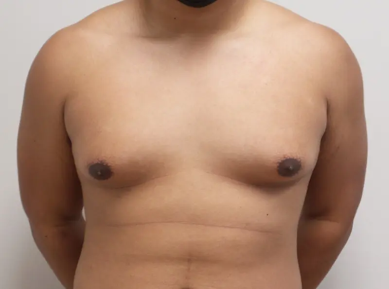 Gynecomastia Before and After Pictures Fort Lauderdale, FL