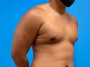 Gynecomastia Before and After Pictures Fort Lauderdale, FL