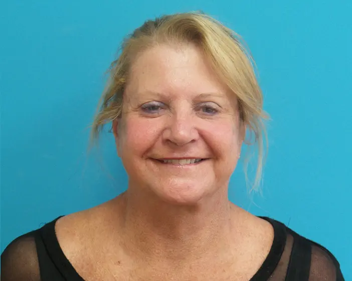 Facelift Blepharoplasty and Browlift after Blepharoplasty Before and After Pictures Fort Lauderdale, FL