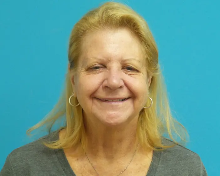 Facelift Blepharoplasty and Browlift before Blepharoplasty Before and After Pictures Fort Lauderdale, FL