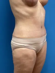 Tummy Tuck Before & After Pictures near Fort Lauderdale, FL