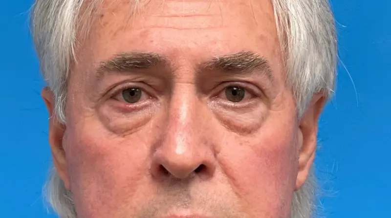 05_28_2021 15_41_00 (1) Blepharoplasty Before and After Pictures Fort Lauderdale, FL