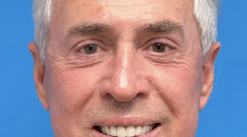 12162021 201300 (1) Blepharoplasty Before and After Pictures Fort Lauderdale, FL