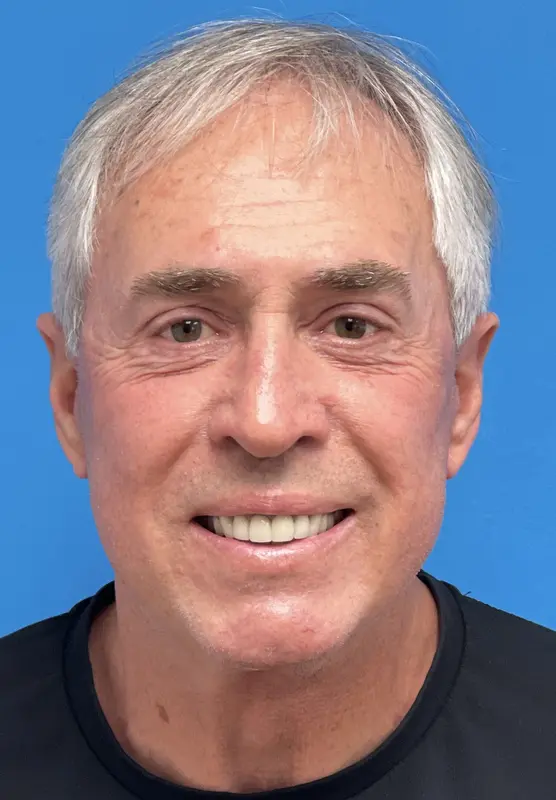 12162021 201300 (3) Facelift Before & After Pictures near Fort Lauderdale, FL