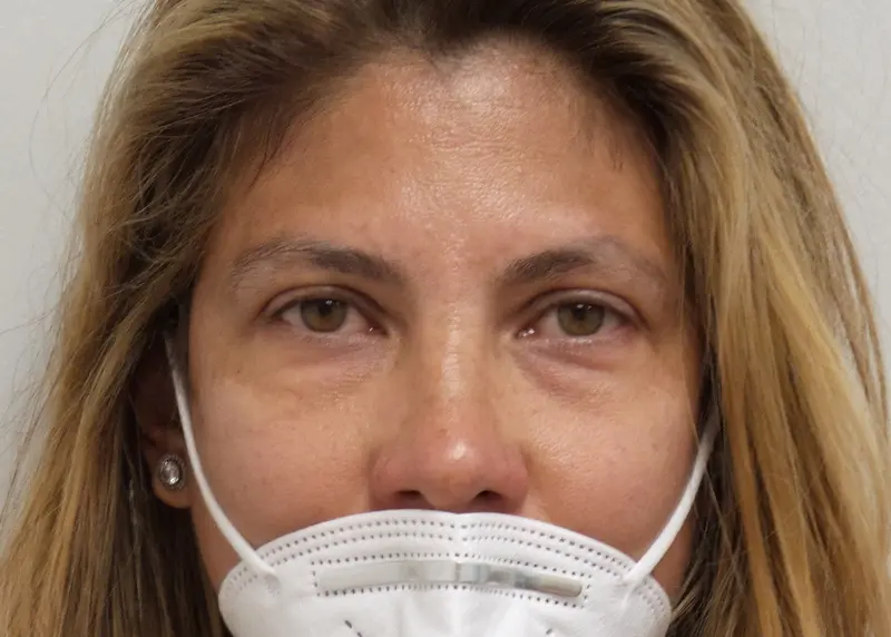 06_08_2020 15_14_00 Blepharoplasty Before and After Pictures Fort Lauderdale, FL
