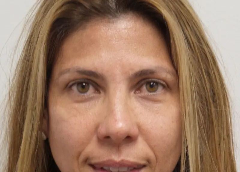 09032020 192600 Blepharoplasty Before and After Pictures Fort Lauderdale, FL
