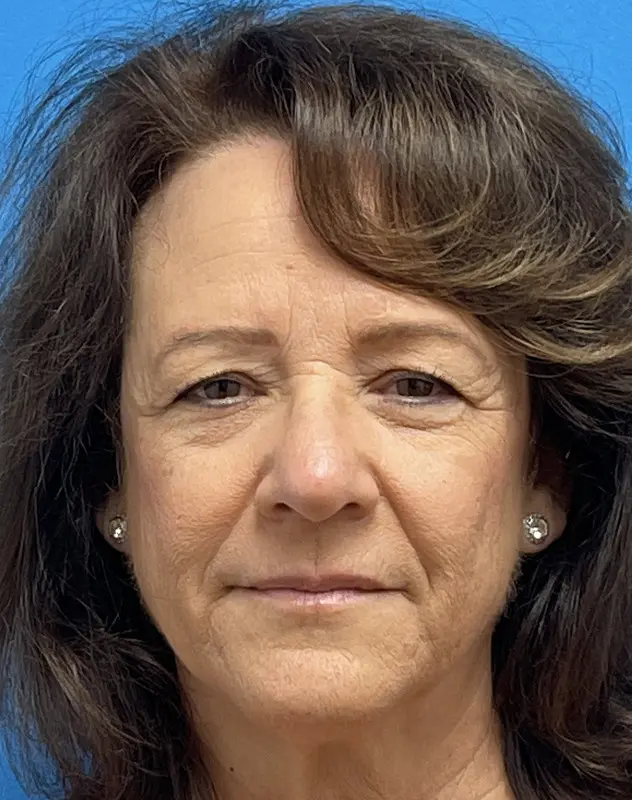 04212022 134200 (3) Brow Lift Before and After Pictures Fort Lauderdale, FL