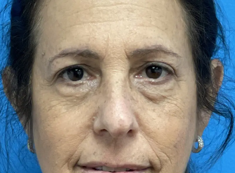 04_06_2021 17_59_00-001 Blepharoplasty Before and After Pictures Fort Lauderdale, FL