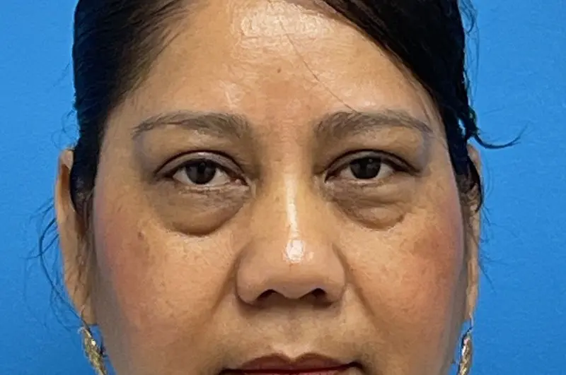 01242024 150600 Blepharoplasty Before and After Pictures Fort Lauderdale, FL