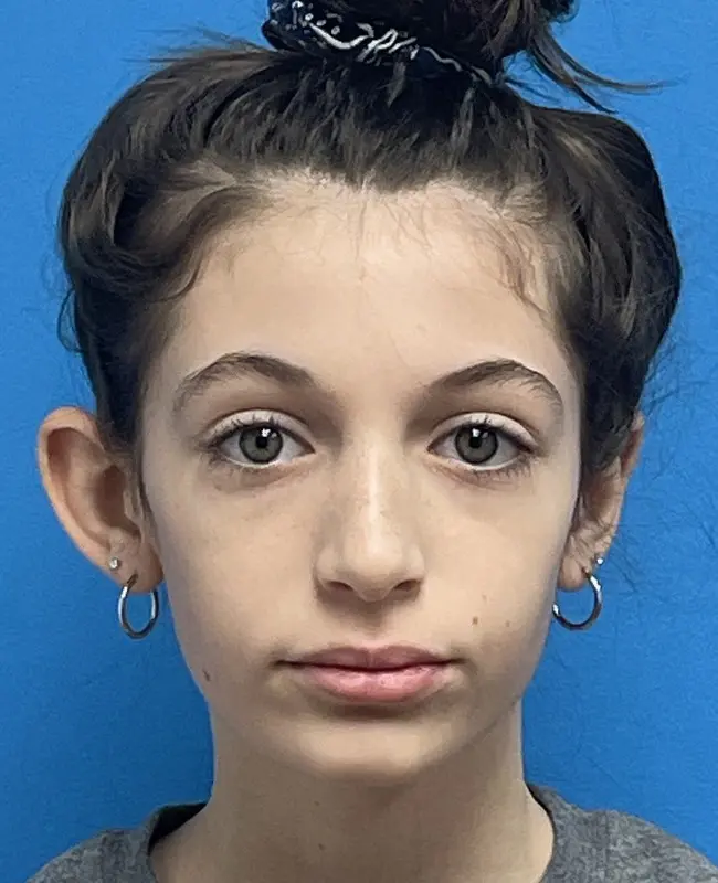 12292023 141400 Otoplasty Before and After Pictures Fort Lauderdale, FL