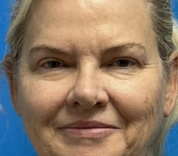 05292024 133600 (10) Blepharoplasty Before and After Pictures Fort Lauderdale, FL