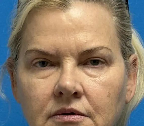 05292024 133600 (9) Blepharoplasty Before and After Pictures Fort Lauderdale, FL