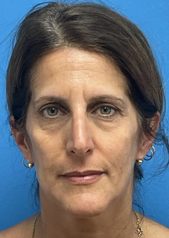 03202024 175500 Blepharoplasty Before & After Pictures near Fort Lauderdale, FL