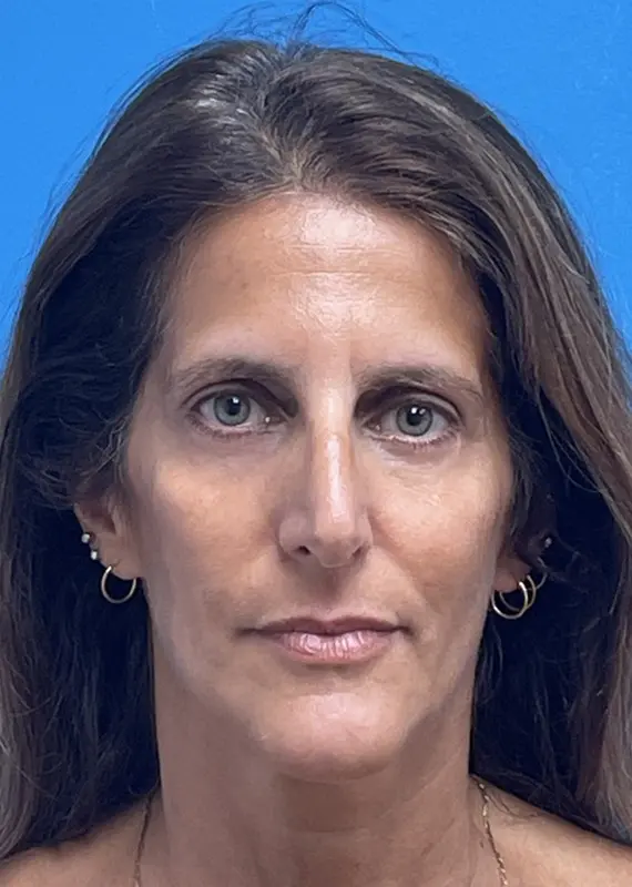 07262024 144600 Blepharoplasty Before & After Pictures near Fort Lauderdale, FL