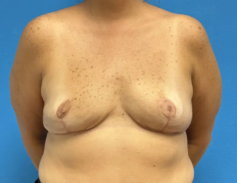Breast Implant Removal Before & After Pictures near Fort Lauderdale, FL